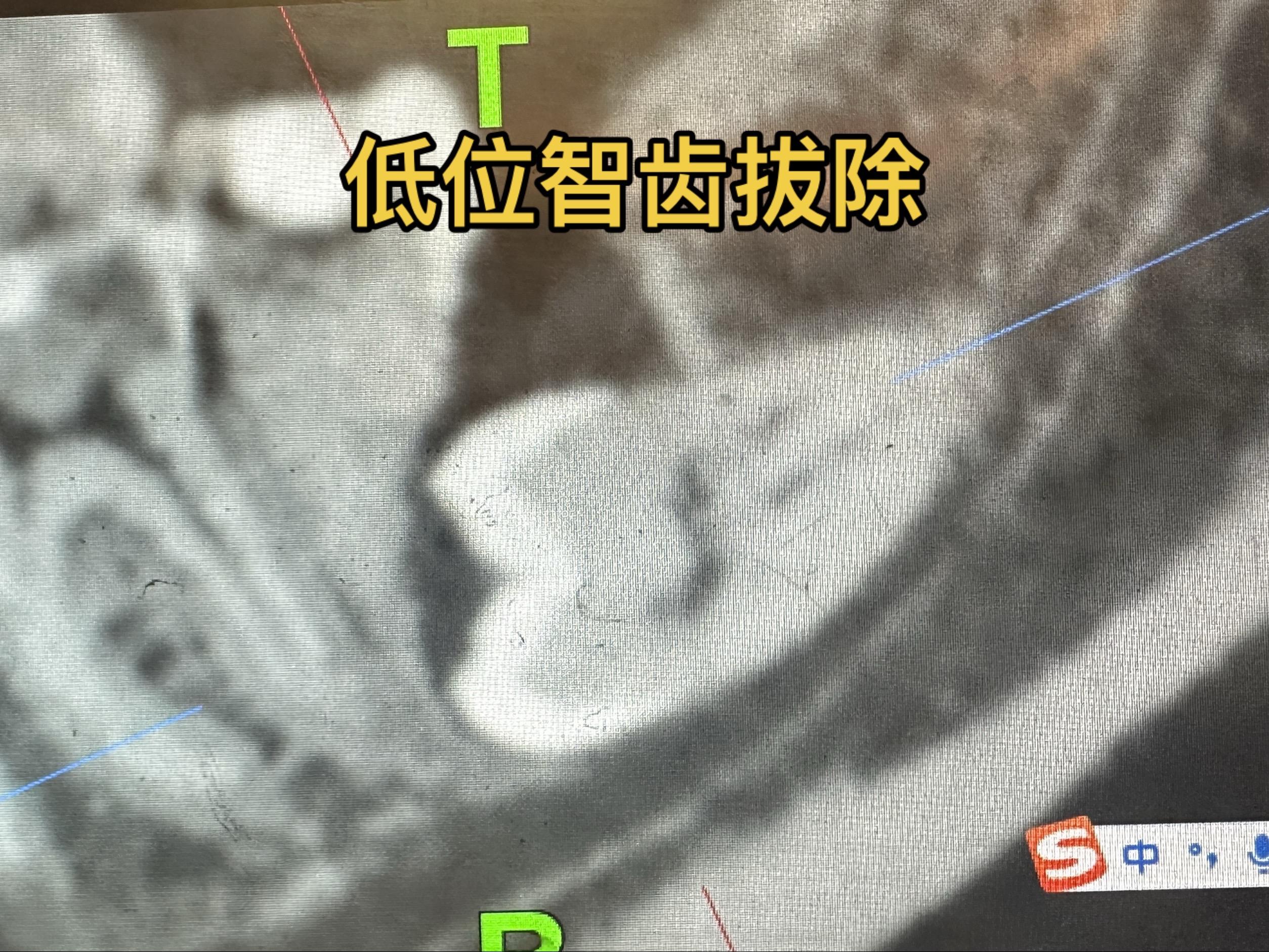 低位智齿拔除。患者是手术室护士老师的妹妹，她的治疗医生要求拔除，答应了...