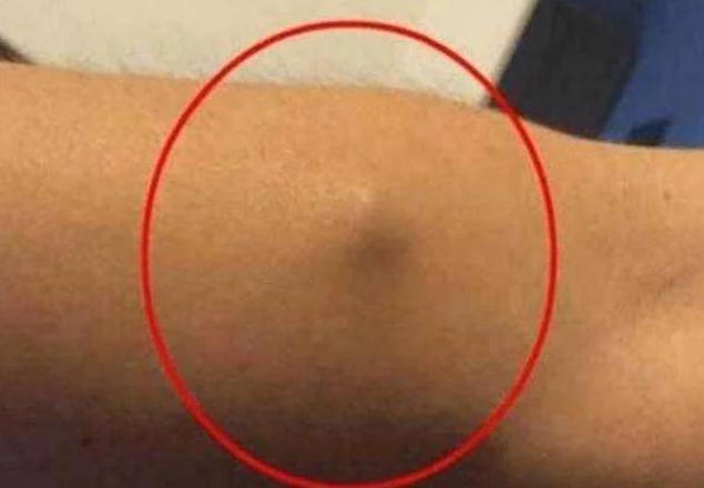 健脾化痰丸，两味药一补一消化脂肪瘤[给力][给力][给力]

先了解下，什么是脂