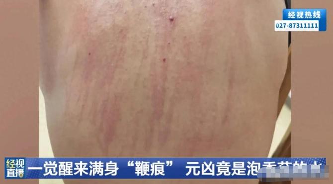 匪夷所思！武汉，一男子睡醒后背、腰腹、胸口布满大片红印，像被鞭子狠狠抽过一样，不