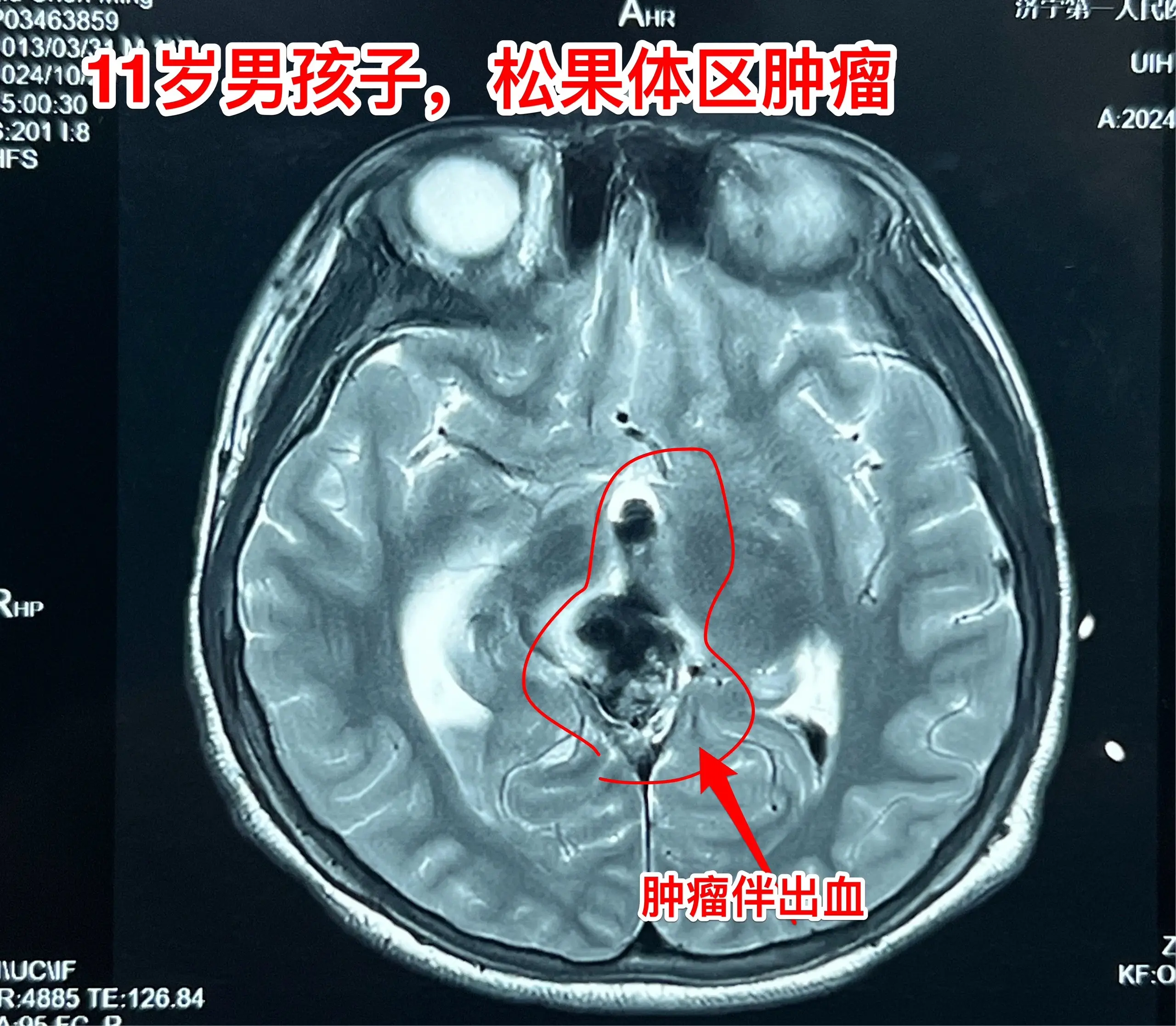 金乡县11岁男孩子突发 脑部出血。天有不测风云！ 11岁男孩子，山东省...