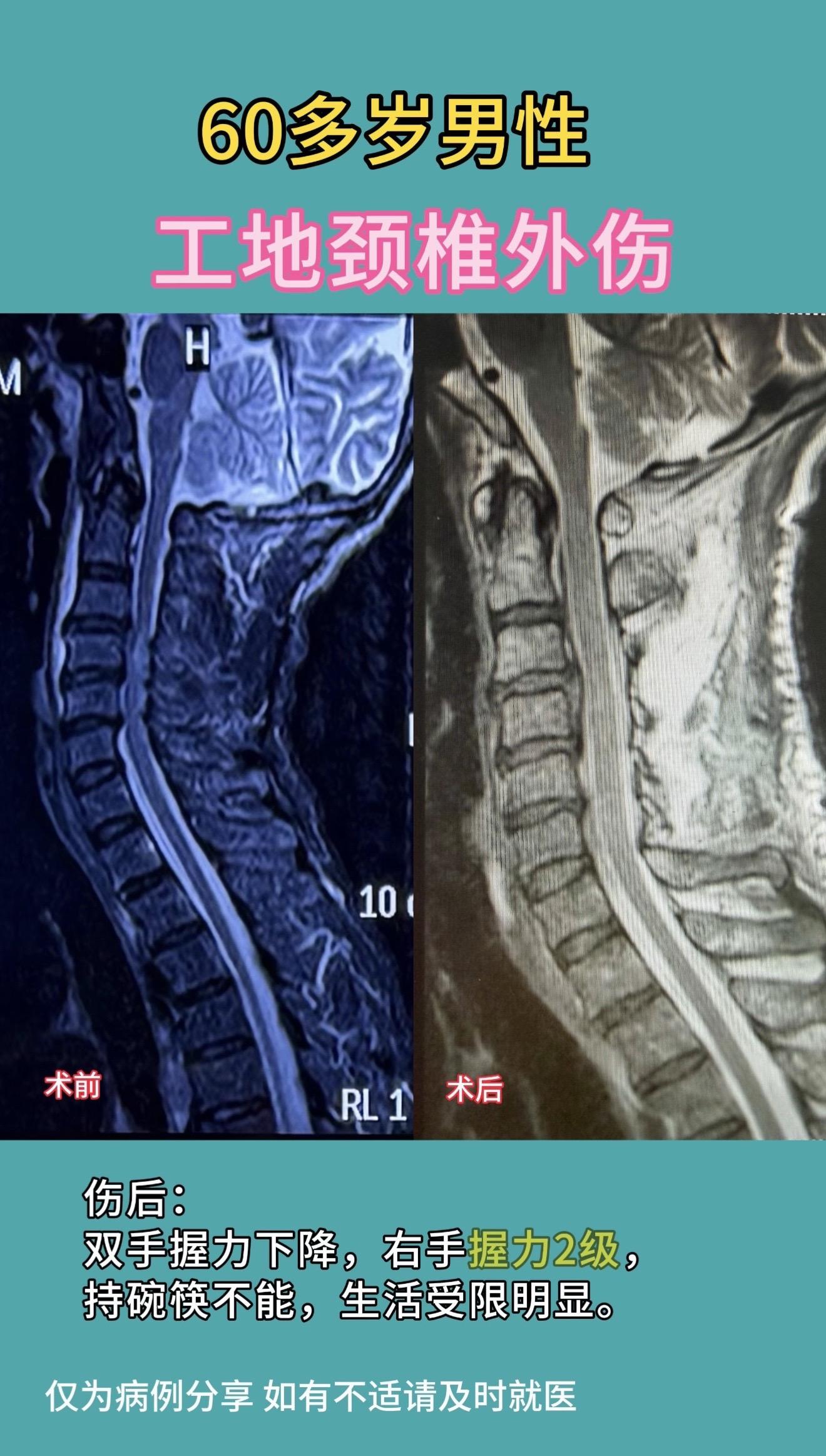 60多岁男性，工地颈椎外伤，伤后双手握力下降，右手握力2级，持碗筷不能...