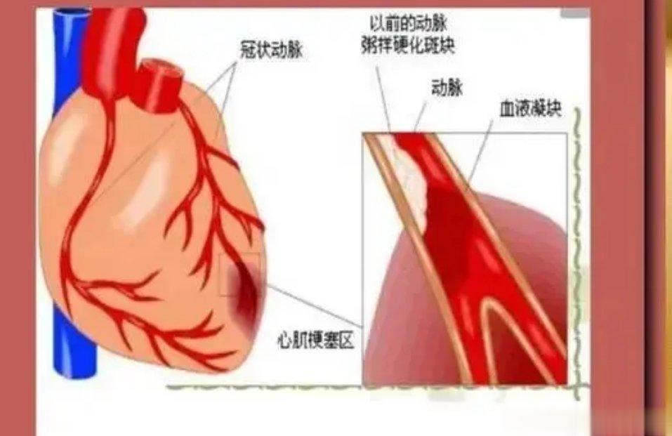 出现10个症状，可能是冠心病病情加重了，中老年人要自检一下！1、呼吸困难。冠心病
