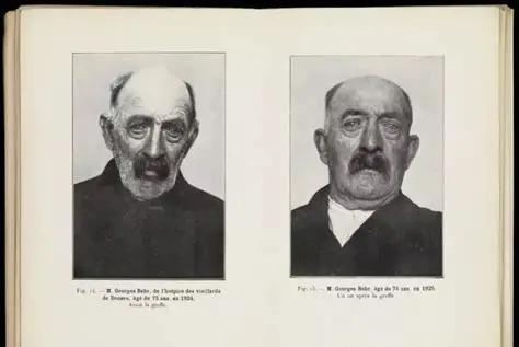 他执着于把猴睾丸移植到男性体内，1920年，一位74岁的老人自愿接受了实验，竟然