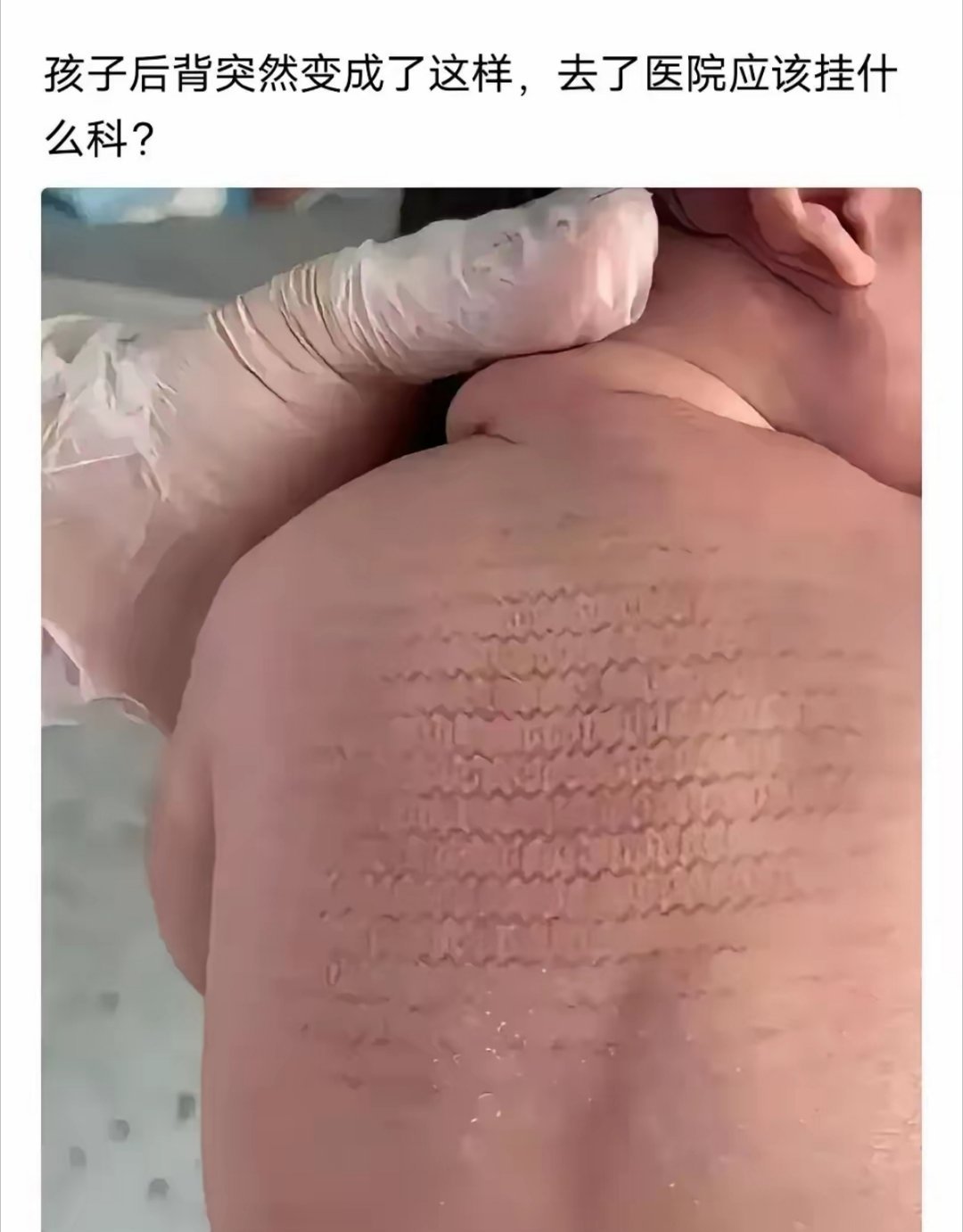 发现孩子后背长这种纹路，去医院挂皮肤科就行 