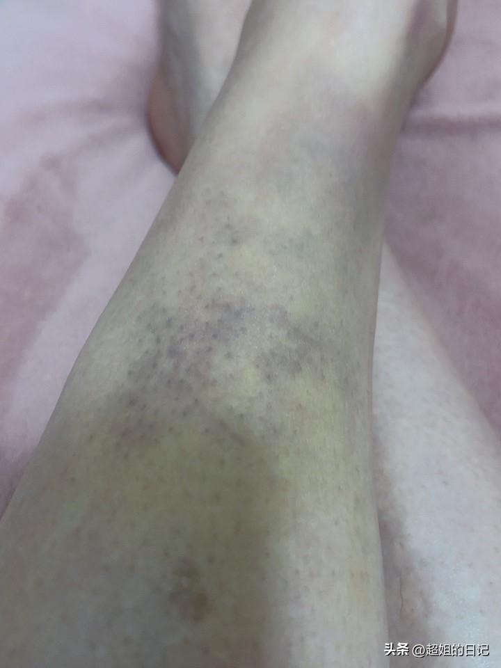 腿上的淤青越来越清楚了，感觉年纪大以后，受点伤，恢复的可慢了。
上次我录视频，有