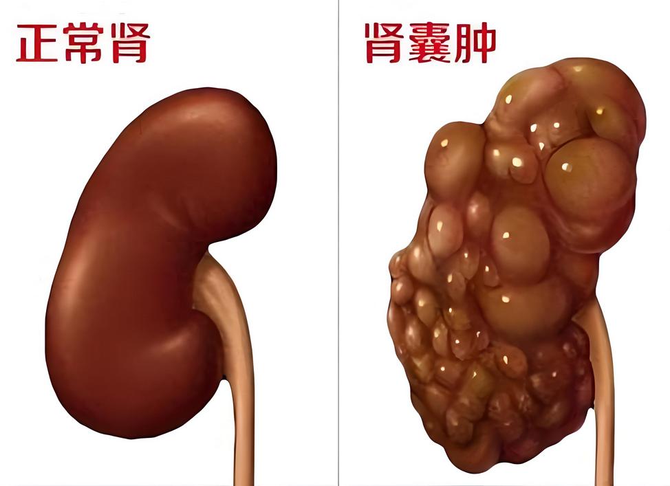 肾囊肿的"消囊方"，别看只有四味药，却是缩小囊肿的"隐形推手"

门诊常遇到患者