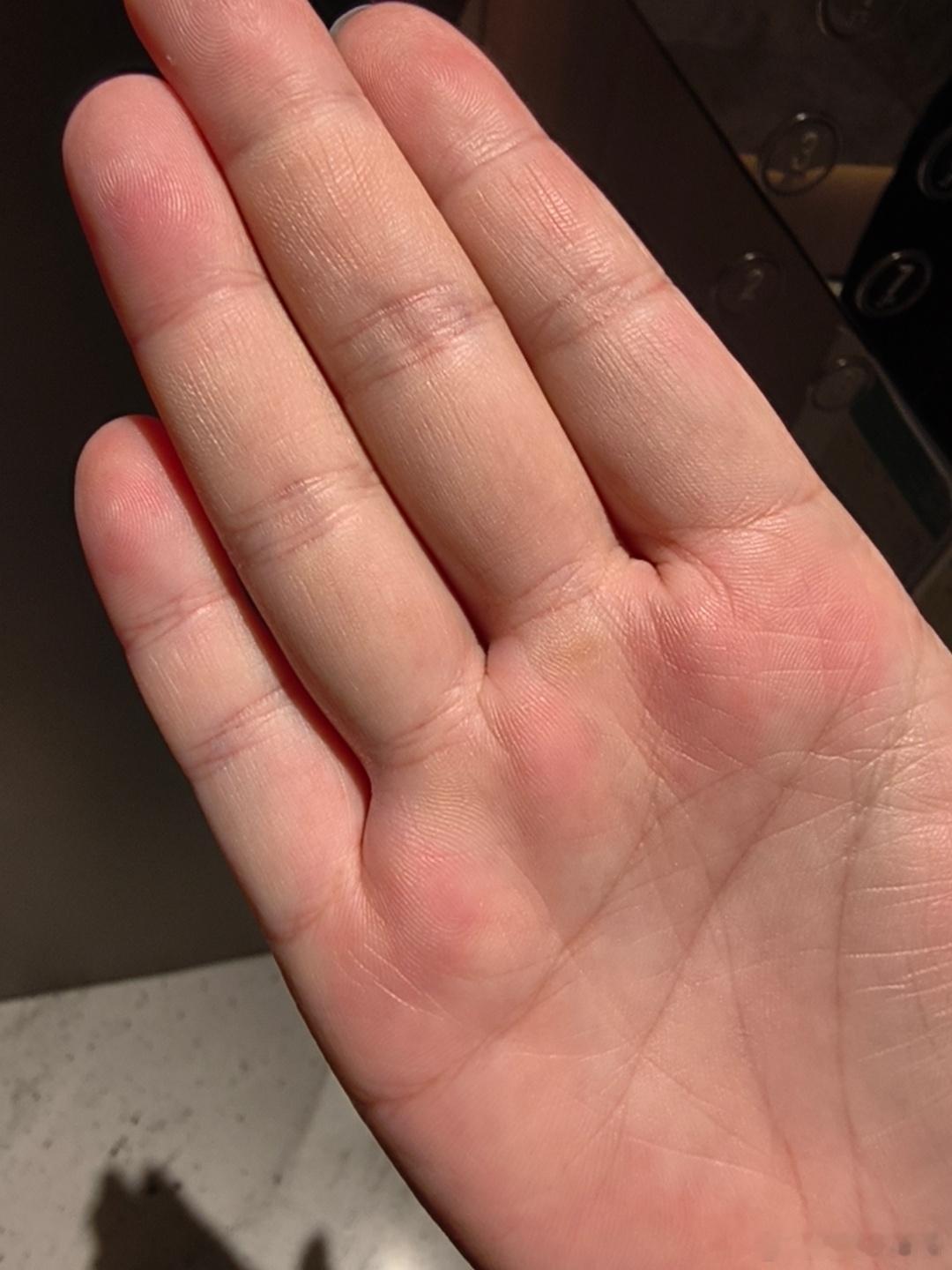 关键是最近吊单杠把老茧都搞出来了，结果给我搞受伤了，真是得不偿失啊，真的好无语啊