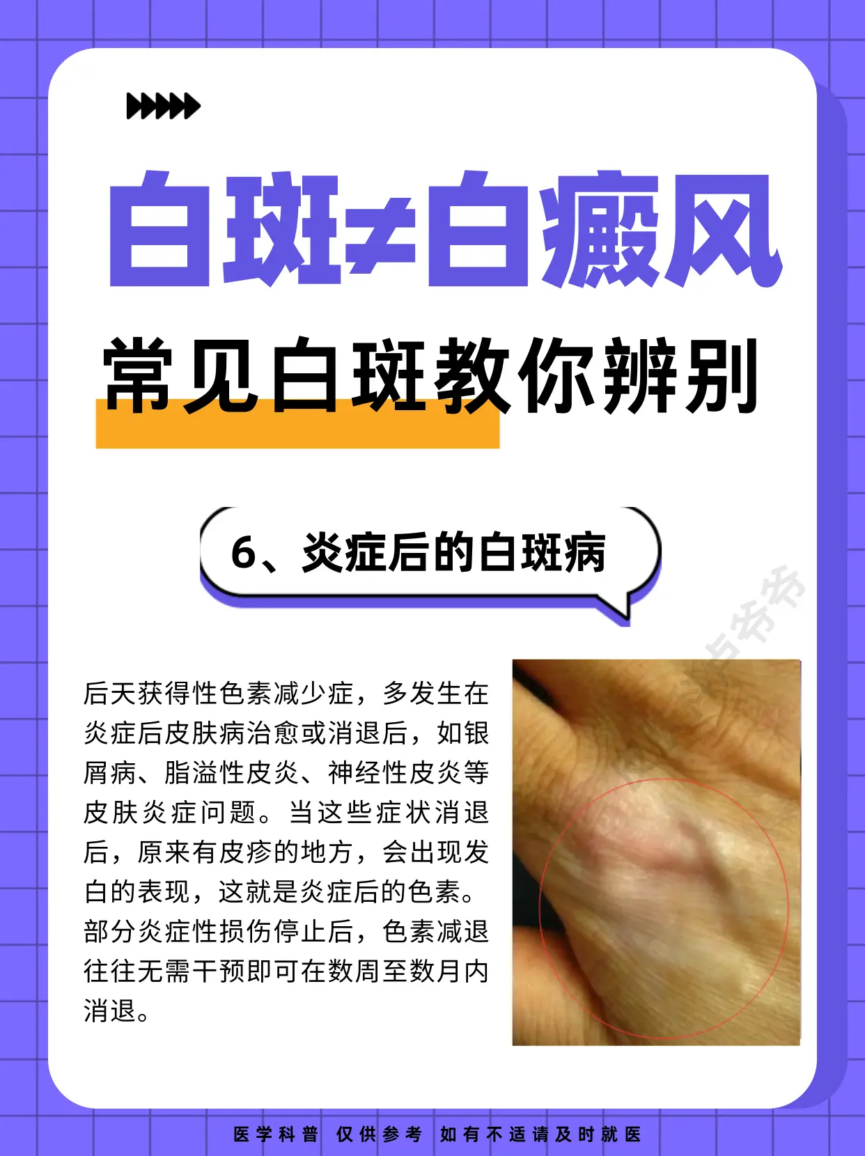 医学科普 白癜风 白斑 硬核健康科普行动 知识分享