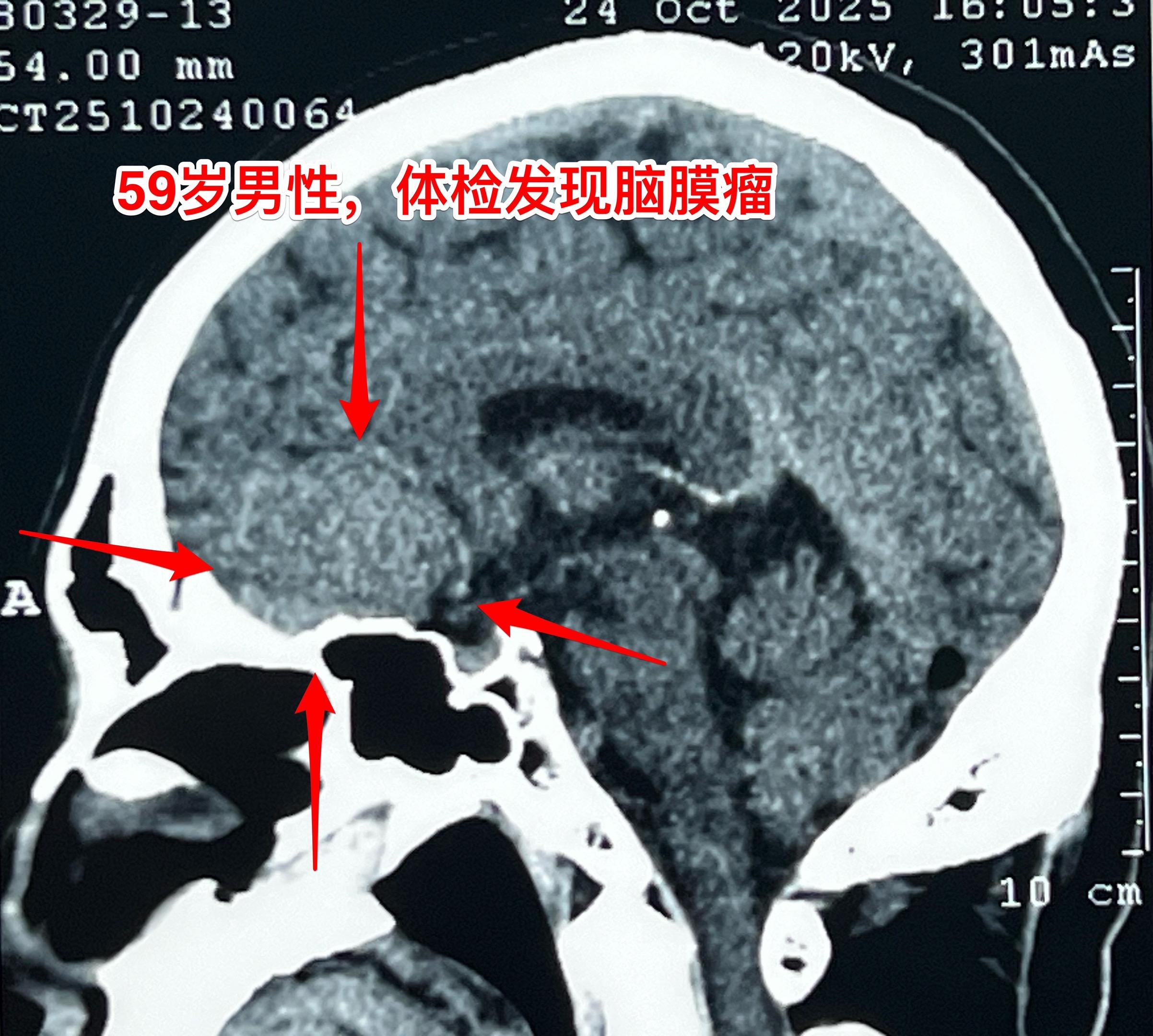 颅底脑膜瘤，彻底切除是首选治疗。59岁男性，体检发现这个肿瘤，无头痛症...