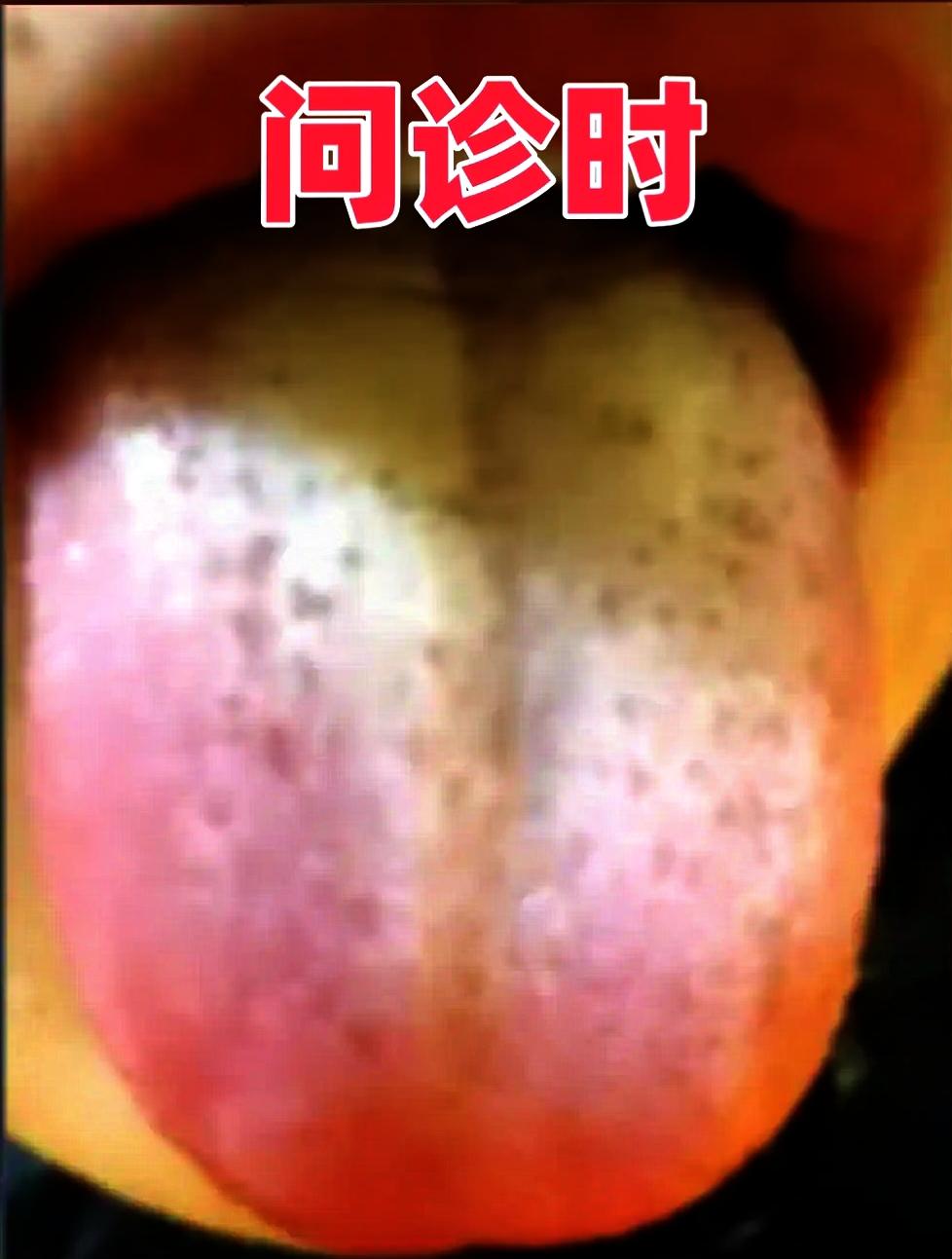 短短20天就把烦人的下焦湿热“一扫而光”了！别再抱怨湿热难治了，咱们这有招！
