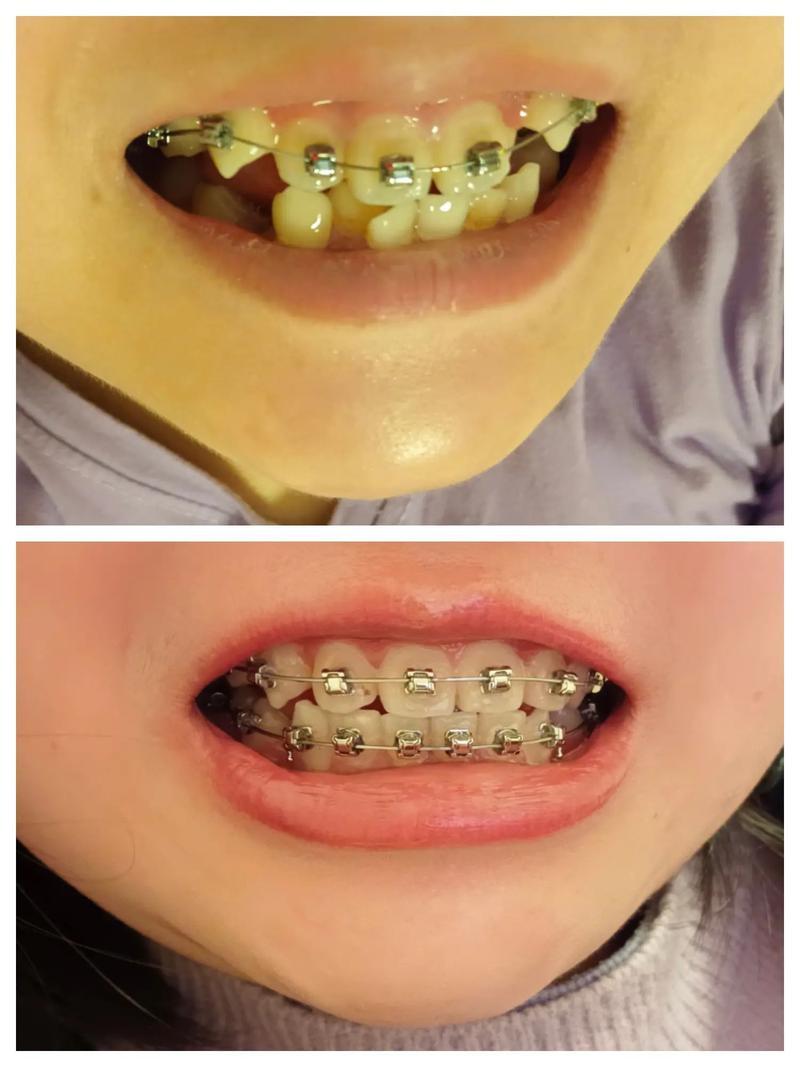 10岁女儿牙齿正畸术日记，第四篇：

距离女儿加装牙箍已经过去了一个星期的时间，