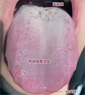 上热下寒致房事秒射病例解读
一、患者主诉
患者主要症状为房事时间短，通常撑不过五