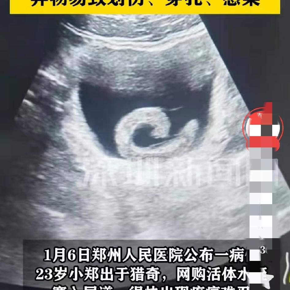 真狠啊！兄弟！
1月6日，
郑州某医院公布了一例病例，23岁男子用5cm活水蛭通
