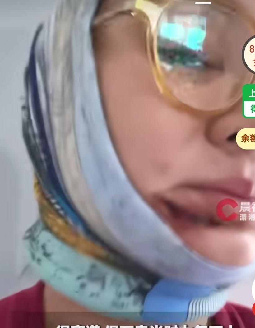 女子拿菜刀切火腿砍伤下巴，刚磨的刀千防万防，怎么也没想到会剁到自己脸上，
近日，