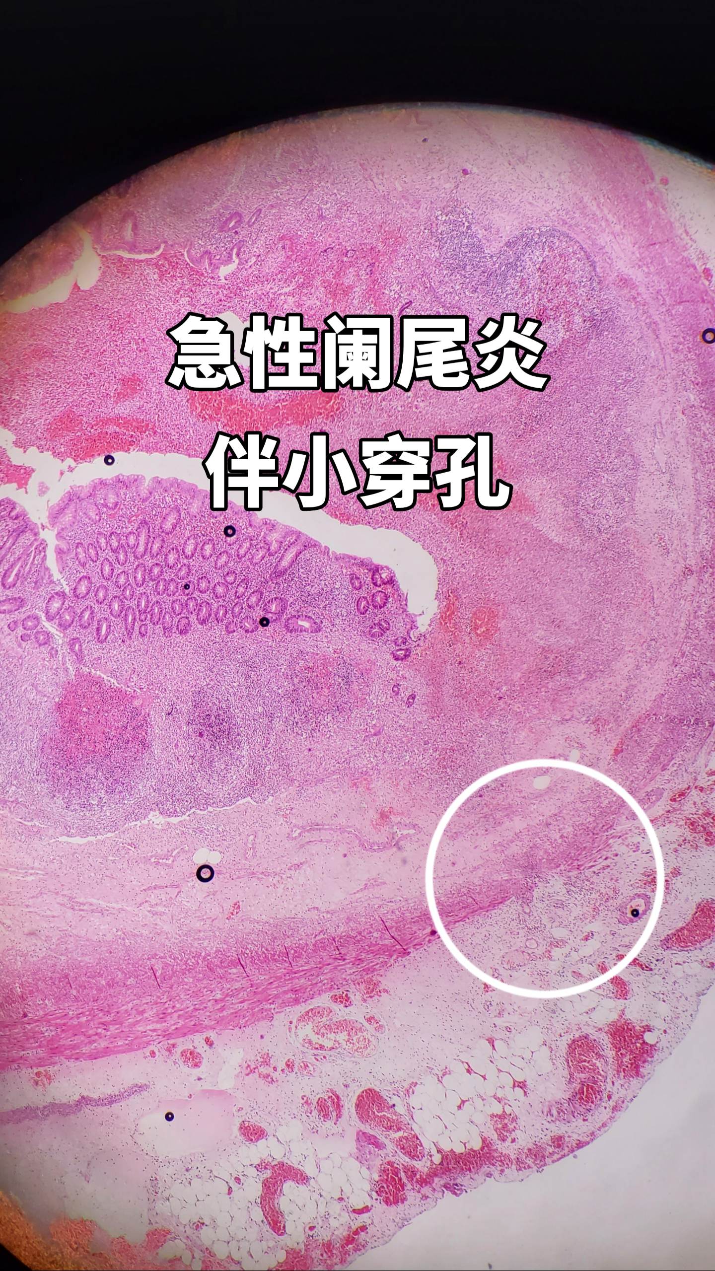 阑尾炎