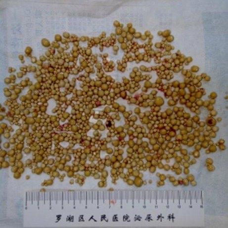 看到深圳有个78岁的老爷子，被排尿困难折磨了好多年，最后去医院做手术，居然从体内