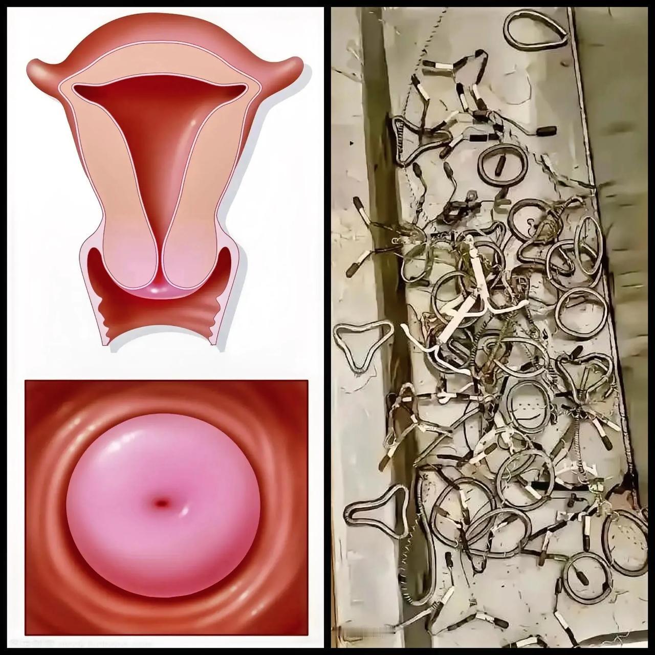 避孕环！[发怒]
为什么，这么多形状！

子宫位于盆腔内，就像一个倒置的鸭梨，外