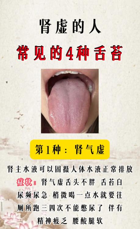 4 种典型肾虚舌象，看看你是哪一种