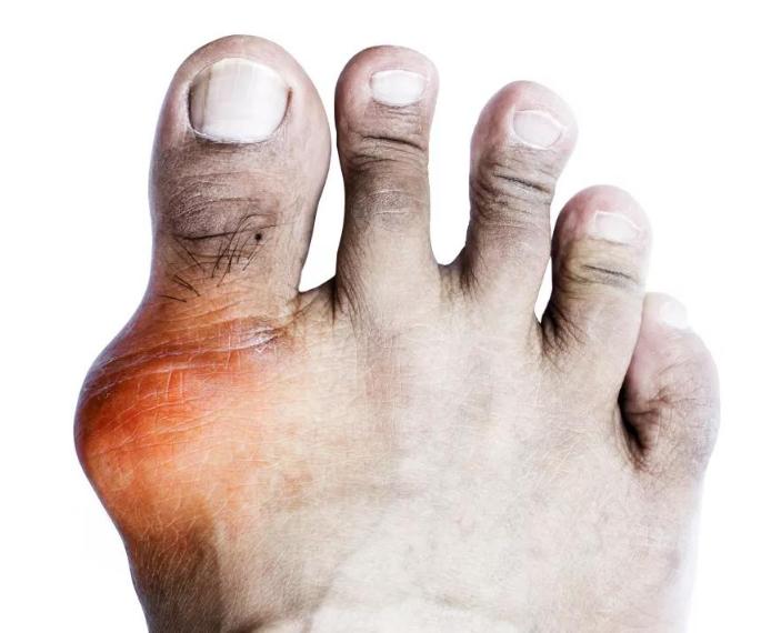 得了痛风，痛如刀割！2味药的小方，快速改善！[谢谢][谢谢][谢谢]

在中医看