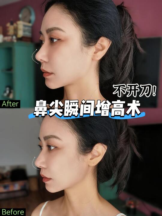 不开刀不注射👃🏻三秒达成鼻尖增高术！
