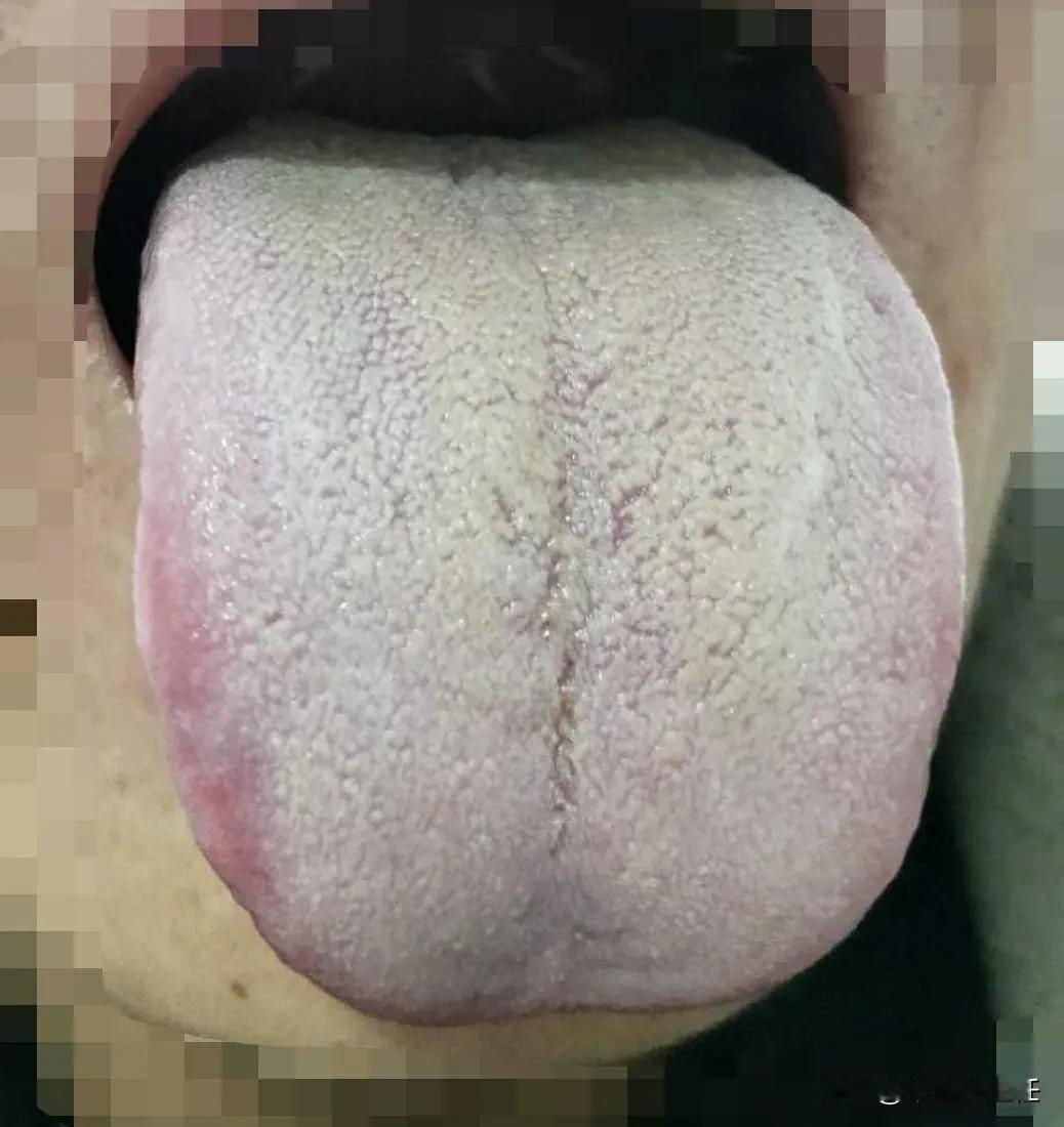 舌苔白厚腻怎么办，教你祛湿，健脾，补肾，无湿一身轻！
这种白厚腻苔，白苔牢固的扒