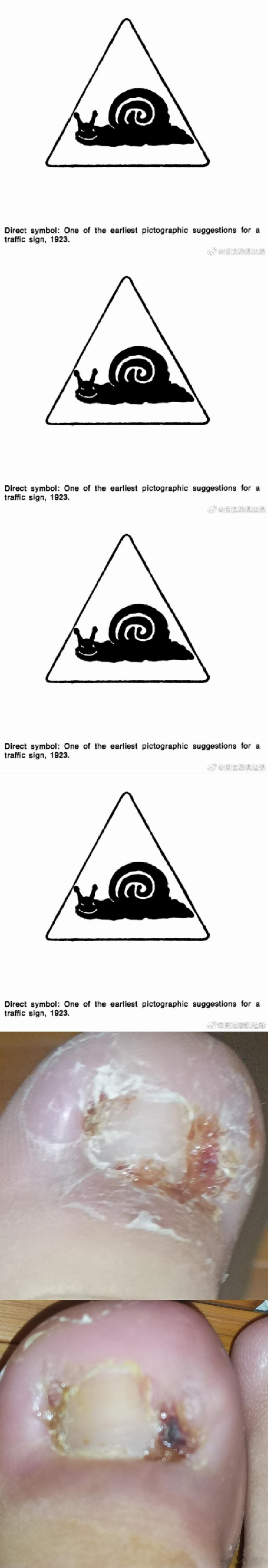 严重的甲沟炎 ​​​