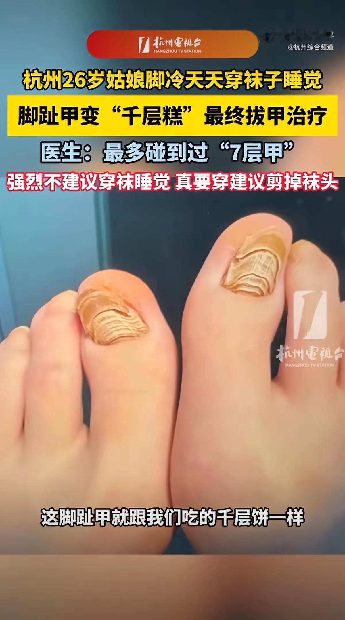 “万万没想到！”浙江杭州，一26岁的姑娘因为怕冷，每天晚上睡觉都穿着袜子，想这样