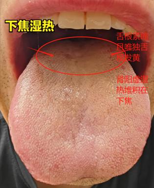 下焦湿热和湿热下注，虽然都是湿热，但是源头和祸根大不同

下焦湿热舌象：整体舌苔