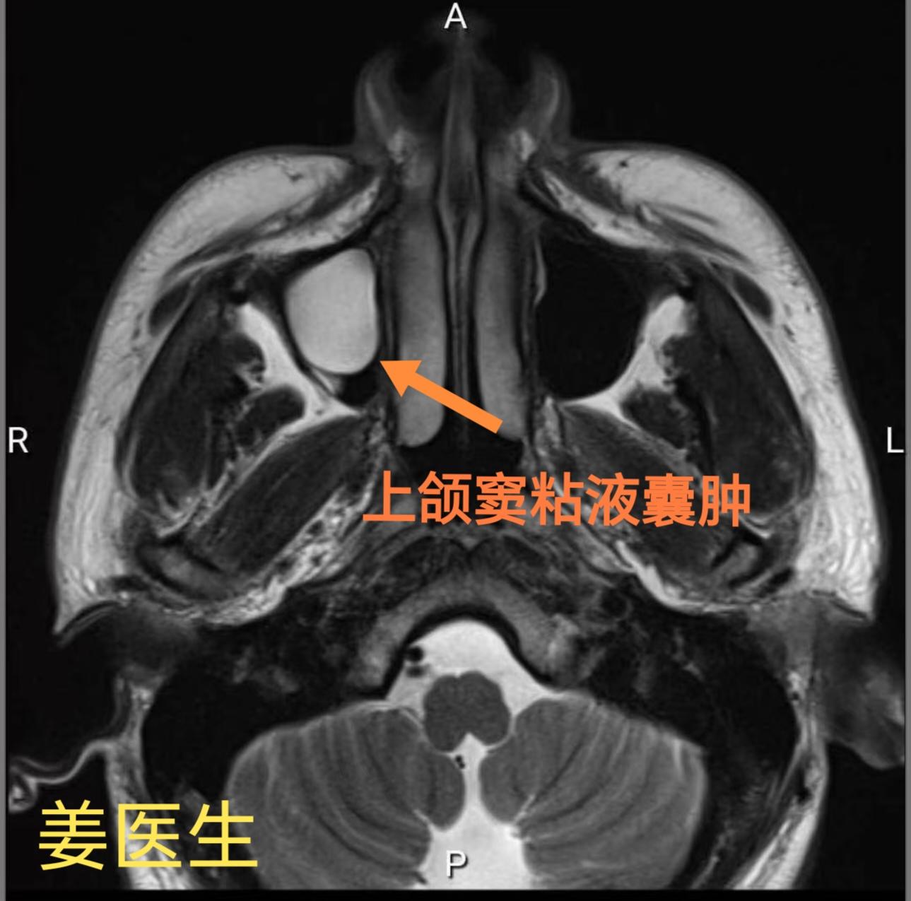 上颌窦粘液囊肿。22年发现上颌窦囊肿，门诊局麻 上颌窦外侧壁开窗取出，未复发。