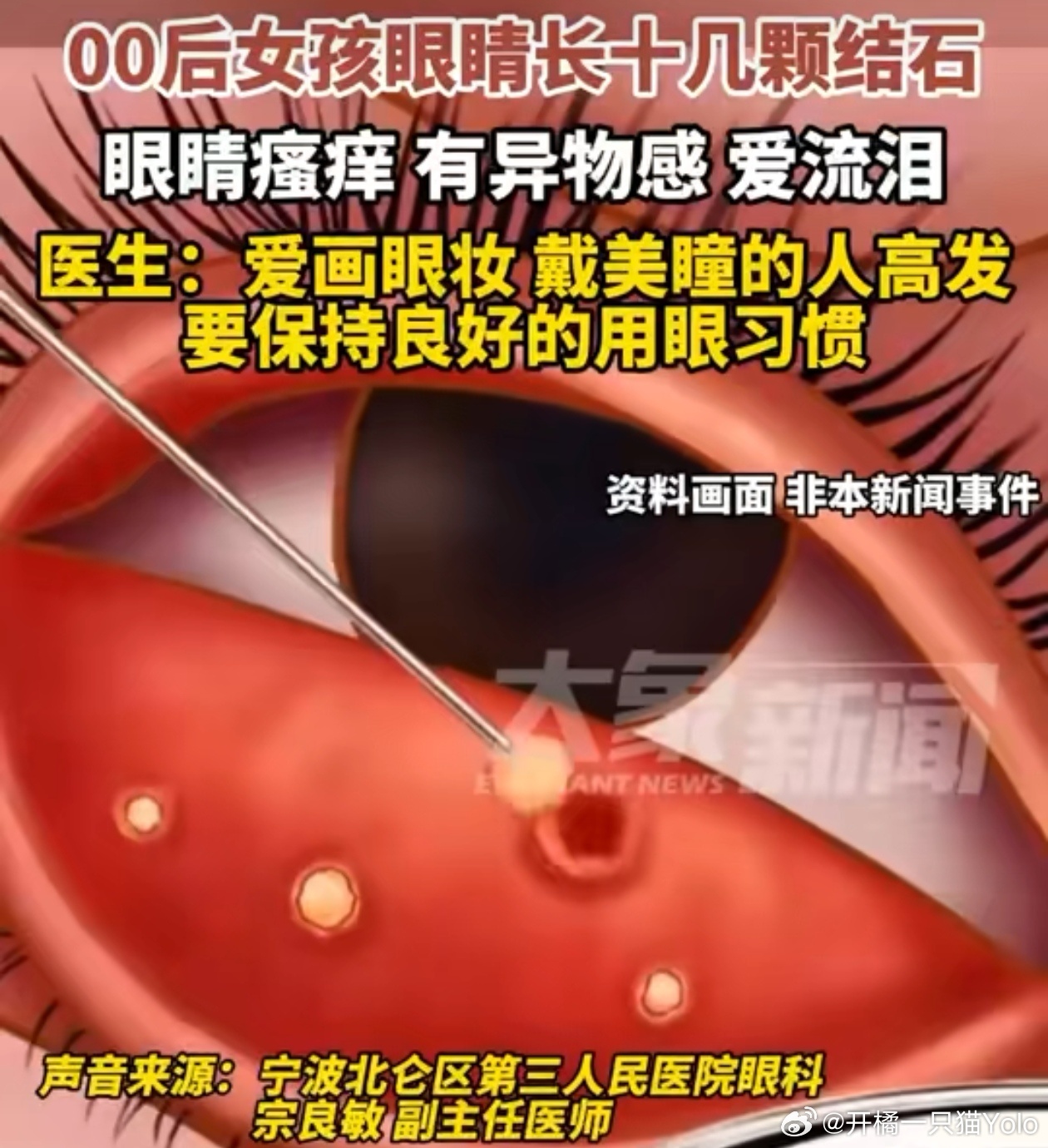 女孩眼睛长10几颗结石我的天第一次听说眼结石的，随机吓薯一个爱戴美瞳的人。 ​​