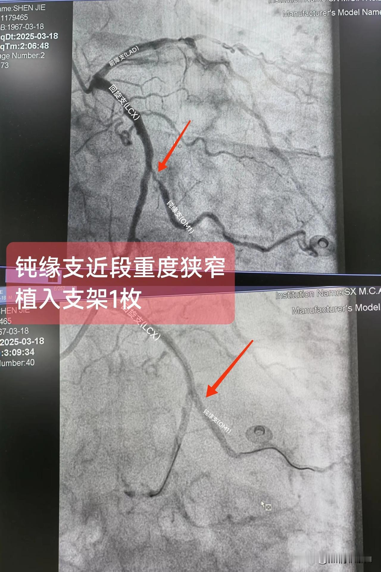 急性非ST段抬高型心肌梗死
（钝缘支近段重度狭窄）

一.概念：钝缘支通常起源于