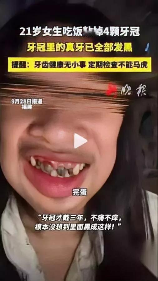 21岁女生牙冠崩了！

张嘴一看当场吓懵……

福建这位姑娘戴了3年的牙冠突然脱