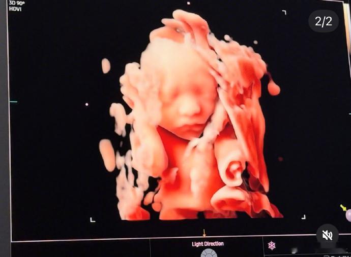 宋承炫宣布当爸宋承炫老婆怀孕 21日，前FTISLAND成员宋承炫晒宝宝B超照，