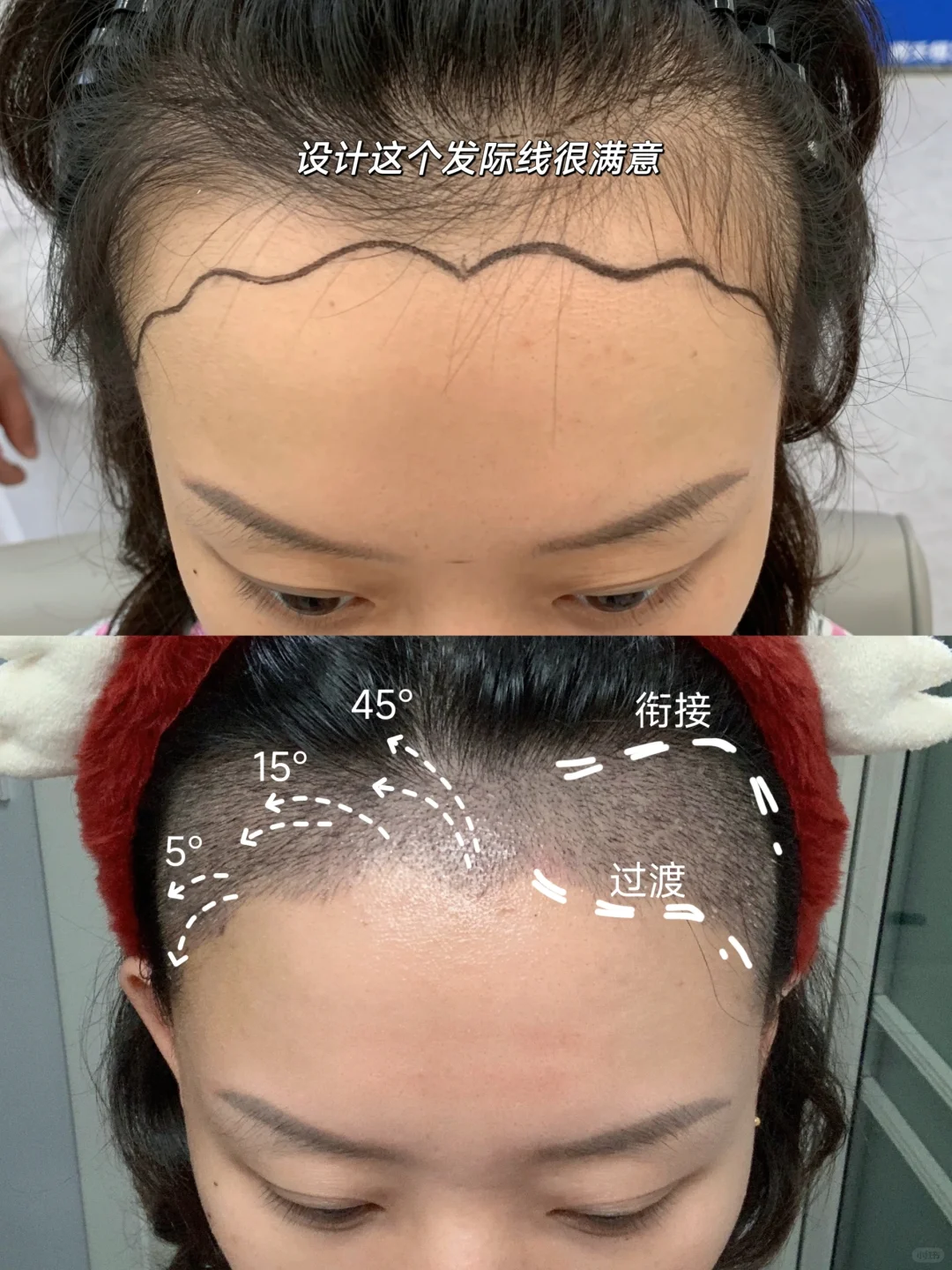 植发记录 气质美女第一步