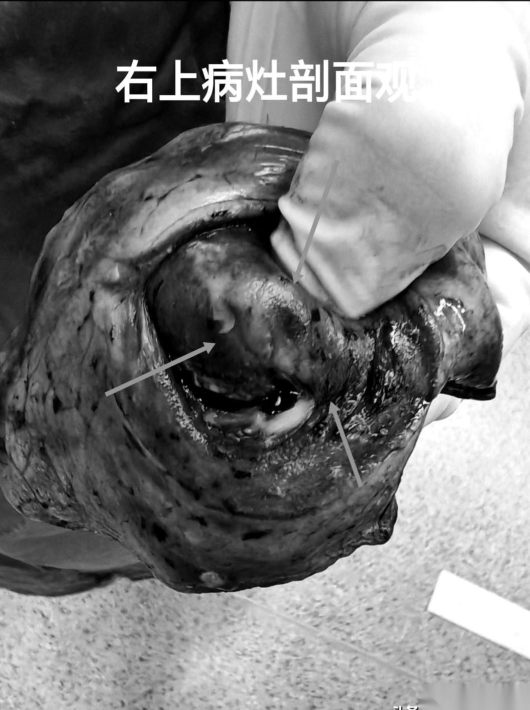 900多公里。
从山东德州，到杭州。
当术中病理结果——“浸润性腺癌”这几个字传