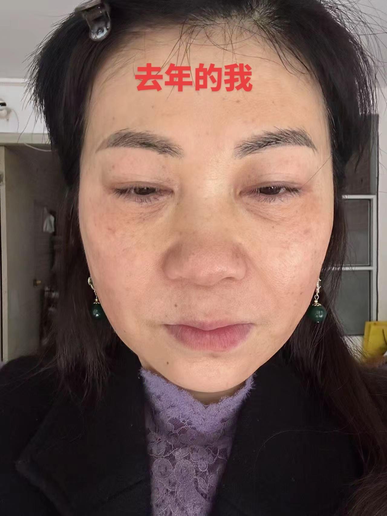 调肤一年零三个月