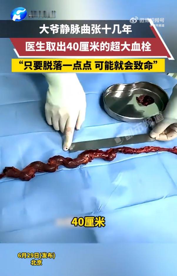 别不拿静脉曲张当回事！

北京一大爷患静脉曲张十几年，一直没放在心上，结果体内长