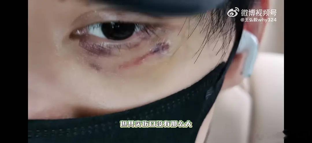 王弘毅之前拍戏受的伤，很久之前了吧？现在伤口还蛮清晰的， 有点严重啊～ 
