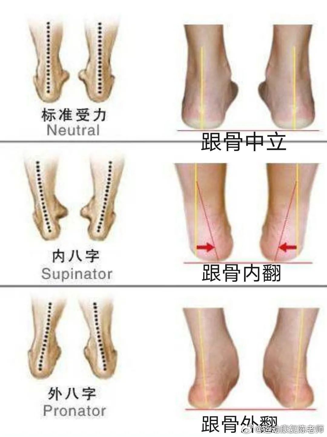 你有脚后跟吗 今天聊一个大家都知道，但平常不会想起来的部位——你的脚后跟，也就是