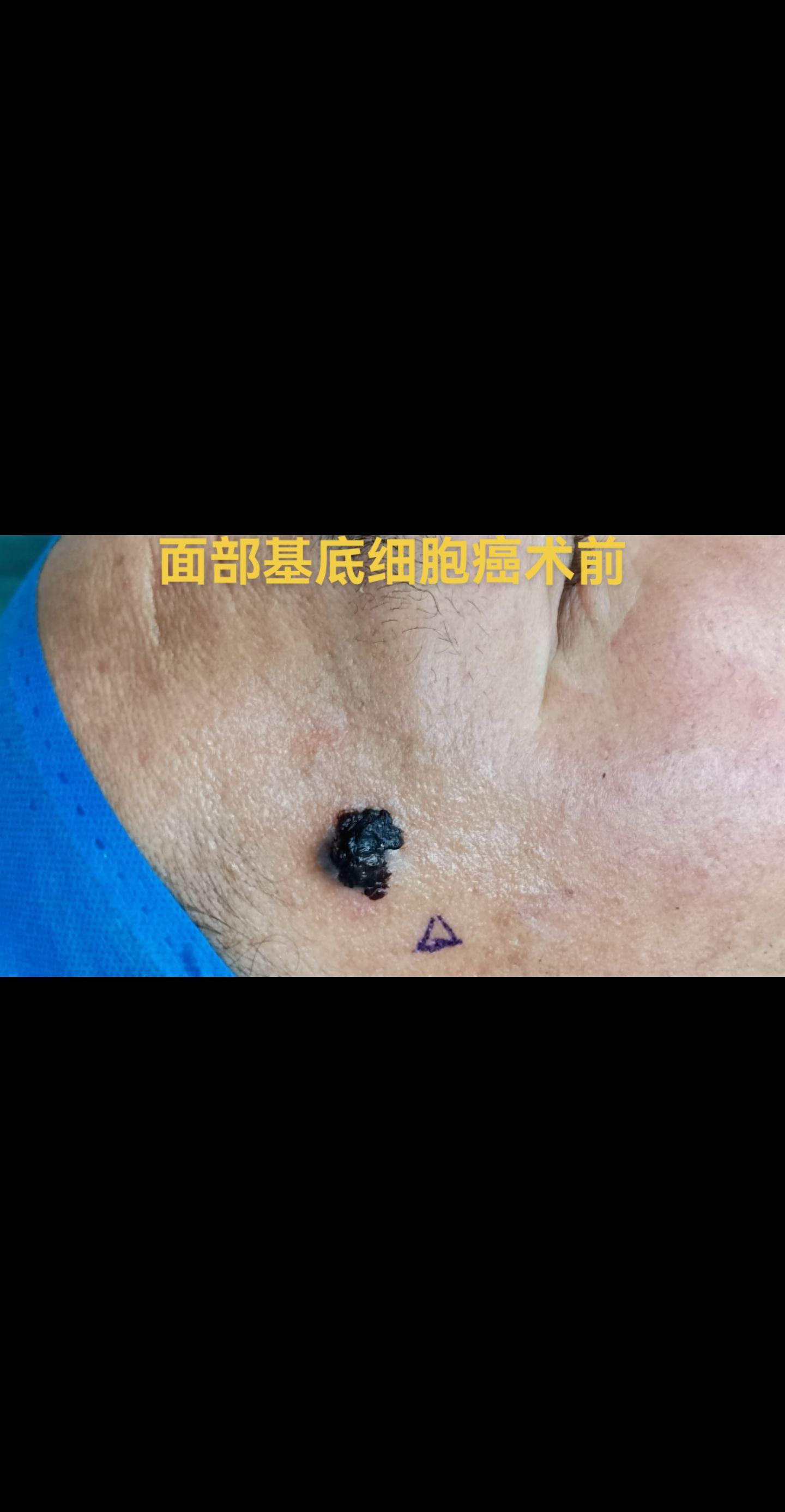 面部基底细胞癌。基底细胞癌是低恶度皮肤癌，多见于老年人，好发于头、面、颈及手背等处，尤其是面部较突出的部位。