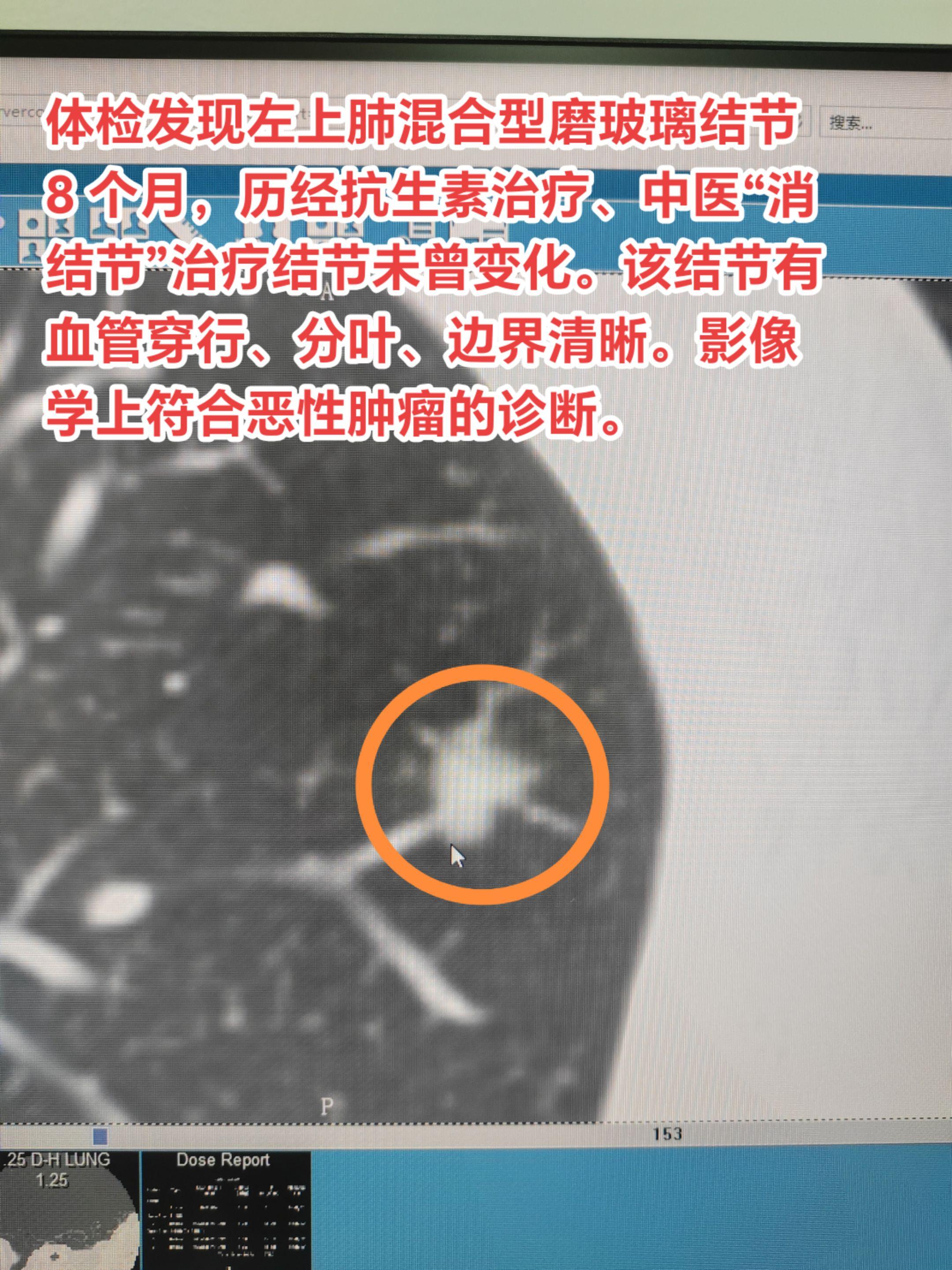 肺结节能用药消掉吗？体检发现左上肺混合型磨玻璃结节 8 个月，历经抗生...