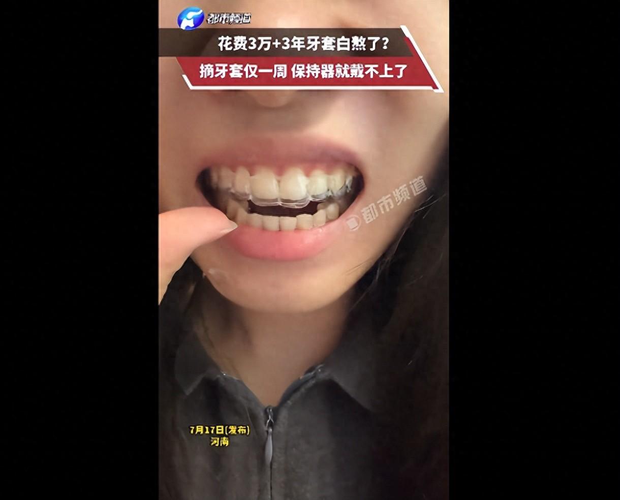 河南一女子砸3万整牙，戴了3年牙套，两年保持器，就才一周没戴保持器，牙套直接卡不