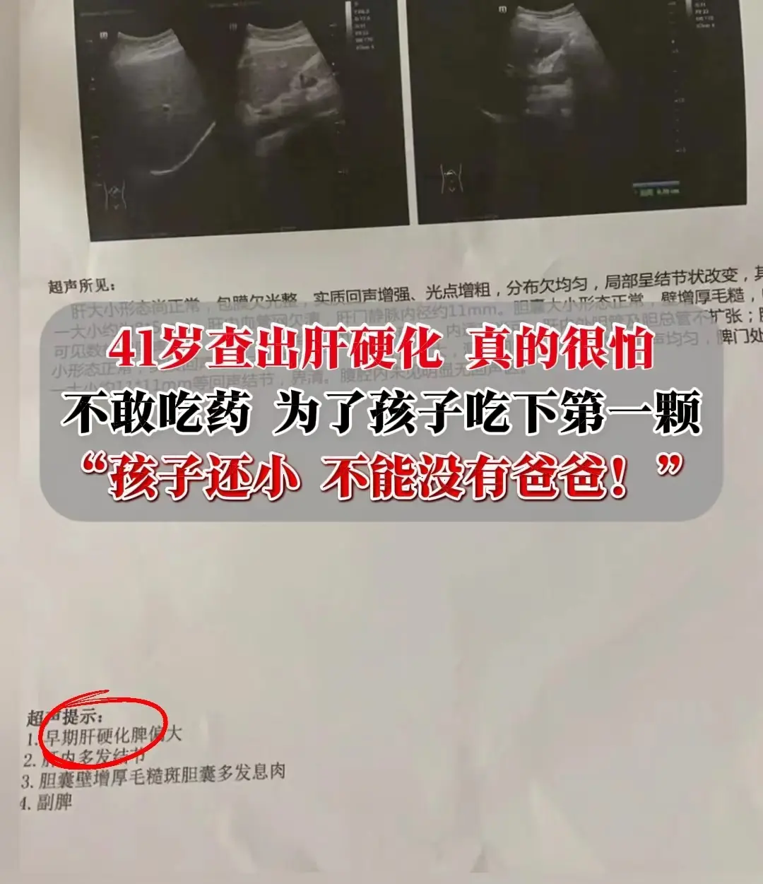 “大夫，我还这么年轻，怎么可能肝硬化，你再查查，再查查吧” 济宁大三阳...