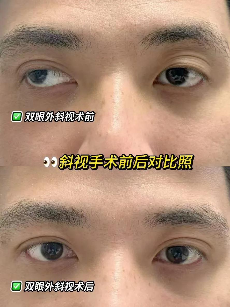 22岁大学生告别斜视+近视
👨‍🎓镇江小伙双眼外斜+近视
✔️在南京东南眼科