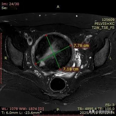 📚【肌瘤7cm+多发也能直接备孕？医生：这情况可以！】💡
 今天分享一个颠覆