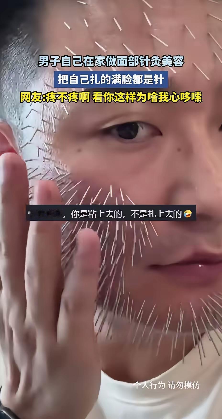 看得头皮发麻！山东小伙脸上扎上百根银针，全程淡定闭眼熟睡！
        山东