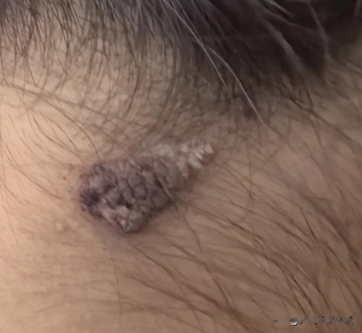 麻烦大家帮我看看，我家小丫头脖子上长的这个东西是什么？原来只有很小的一点像颗痣，