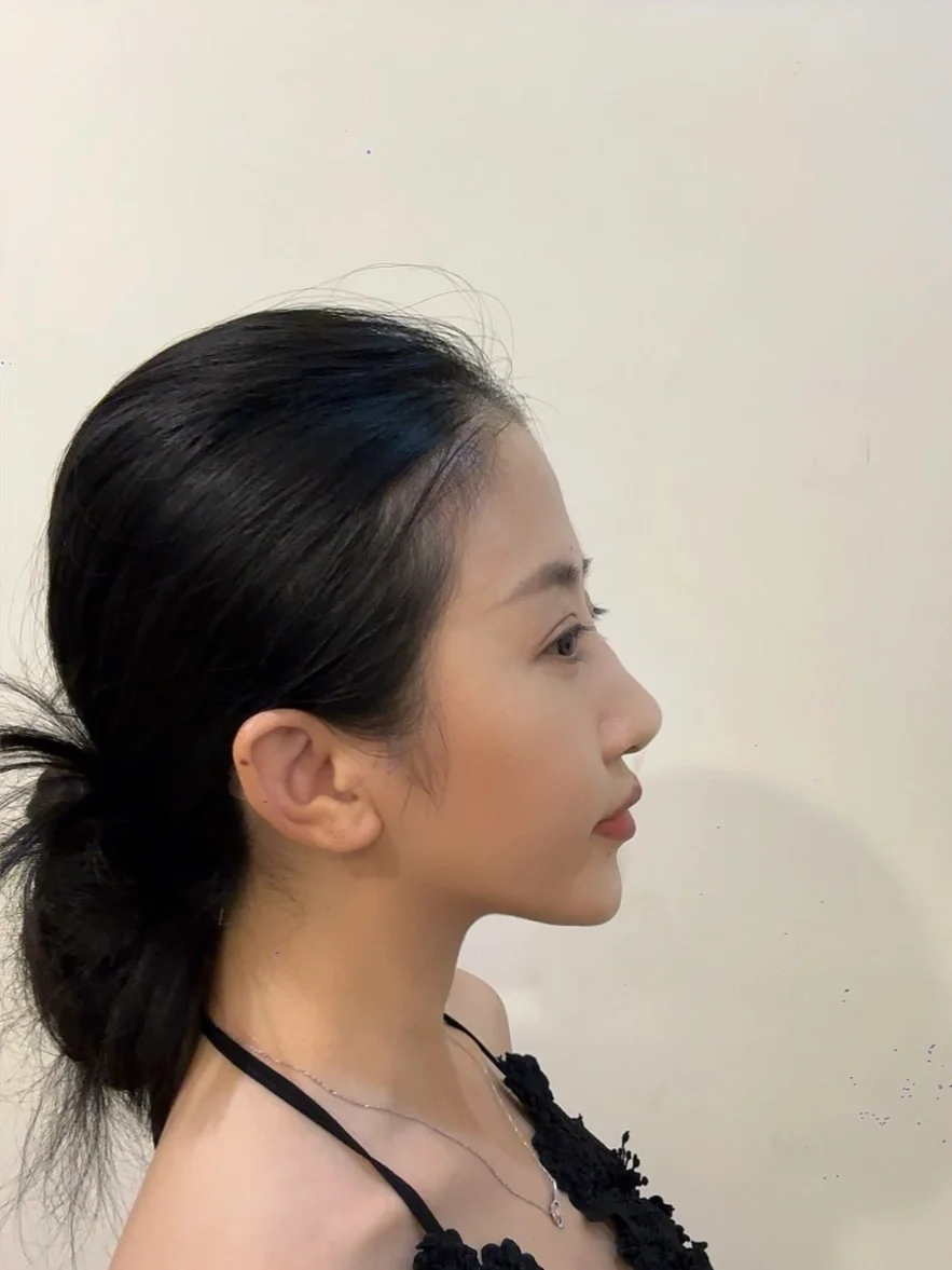 分享三次菲林普利注射鼻，无棍感