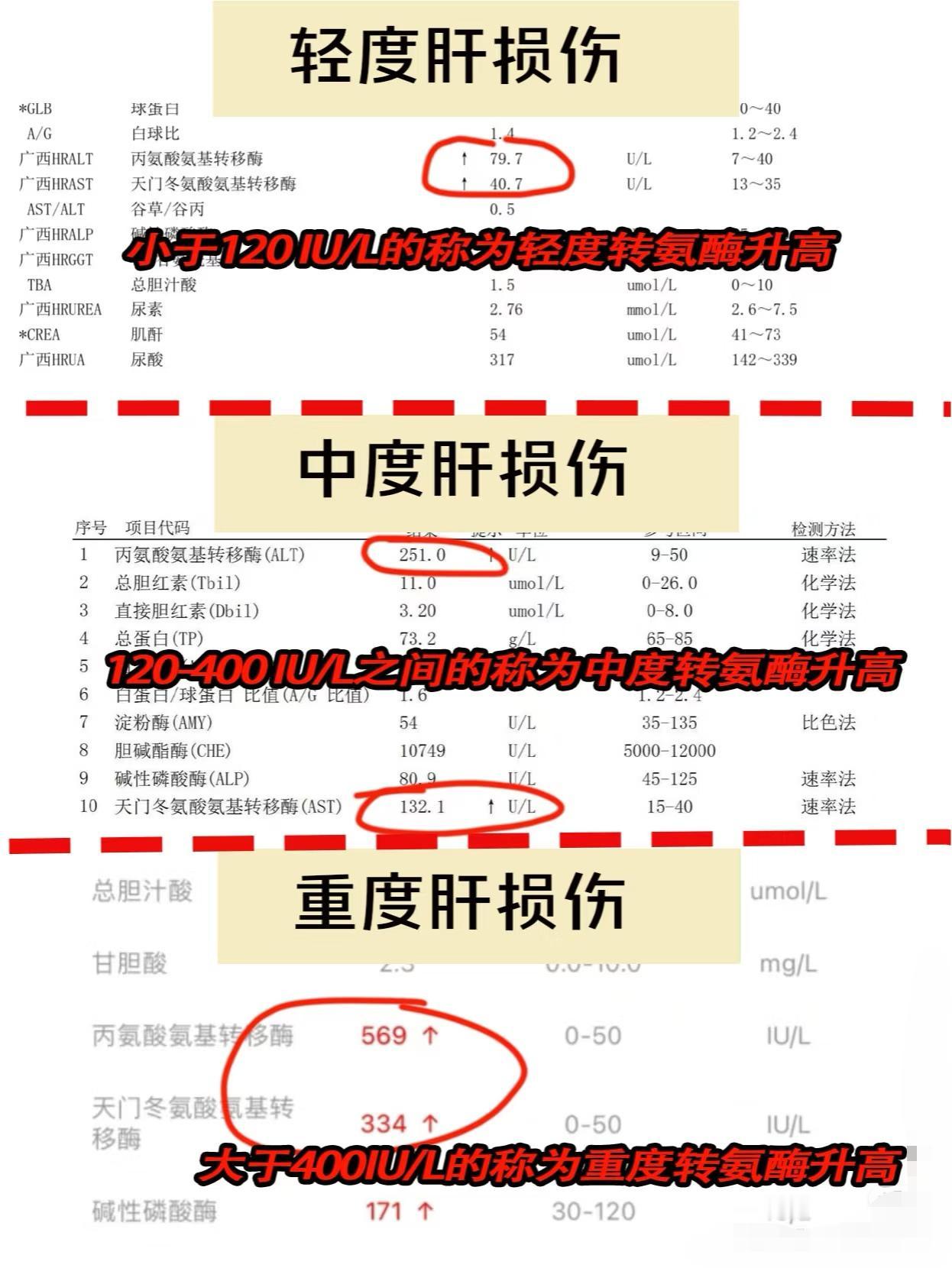 转氨酶升高的3个等级，应该怎么办？
转氨酶是人体代谢过程中必不可少的