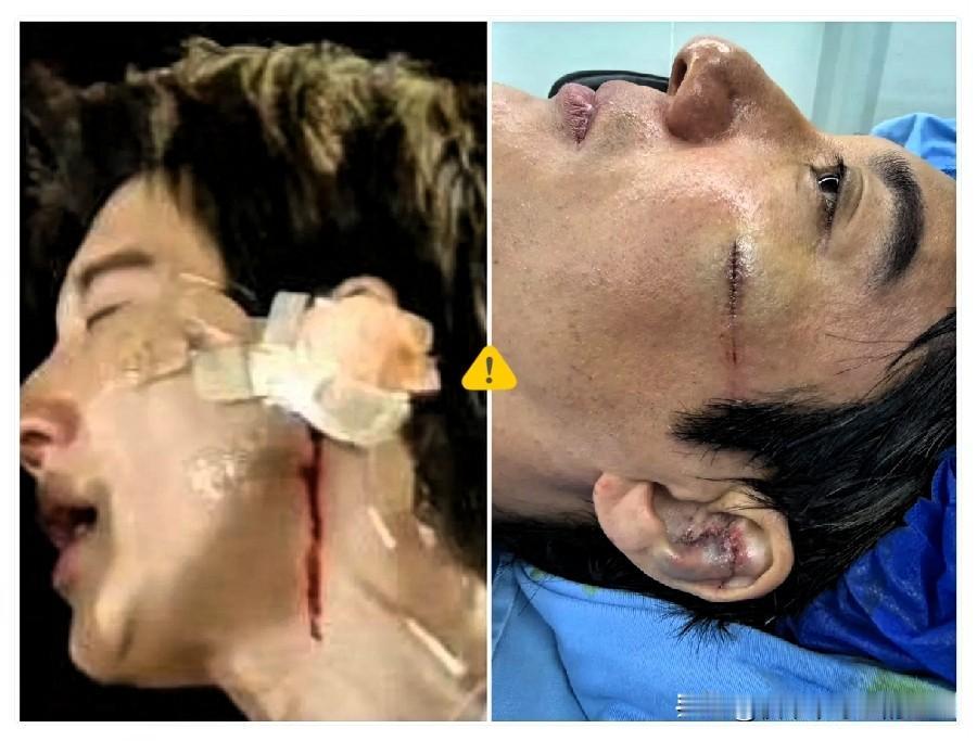 真是外行看热闹，内行看门道！
我朋友是医生，他说王力宏演唱会绊倒磕伤耳朵，看着只